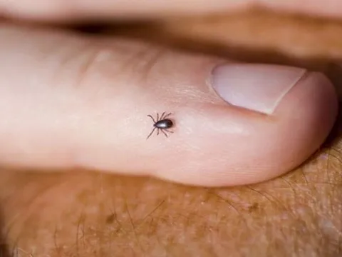 Đáng sợ bệnh "khóc ra máu", có thể gây tử vong tới 40% chỉ sau cơn sốt