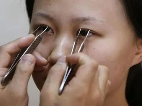 "Tiền mất tật mang" vì muốn có đôi mắt "như mơ"