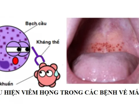 Tưởng bị đau họng bình thường, đi khám phát hiện đã mắc ung thư: BS chỉ ra lưu ý cần nhớ