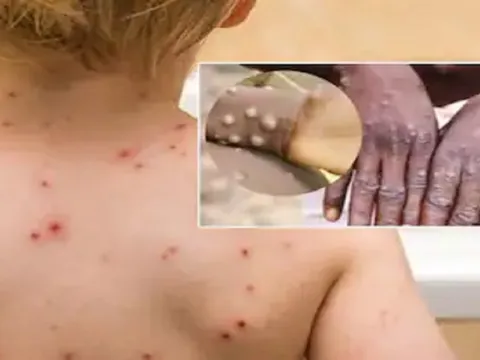 Phân biệt bệnh đậu mùa khỉ và bệnh thủy đậu