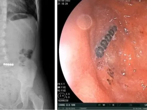 Hoảng hồn phát hiện 5 viên bi nam châm dính nhau trong ruột bé gái