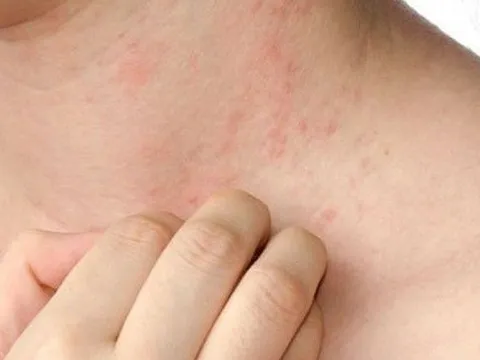 Sốt phát ban ở người lớn có nguy hiểm, khi nào cần nhập viện?