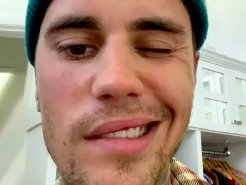 Bệnh liệt cơ mặt mà Justin Bieber đang mắc phải nguy hiểm tới mức nào?