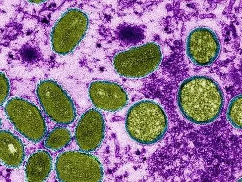 Đậu mùa khỉ: Bằng chứng đột phá về đường lây chưa từng xác nhận
