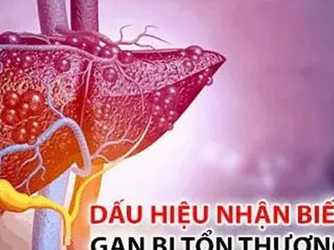 7 dấu hiệu của căn bệnh được ví như "kẻ giết người thầm lặng": Nhận biết để cứu chính mình