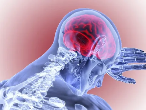 Nghiên cứu mới: Những cách đơn giản để giảm nguy cơ đột quỵ mà ai cũng có thể làm được