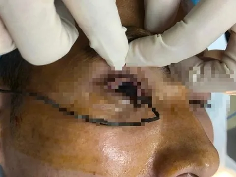 Đang cắt dây thép gai thì gặp tai nạn, nam thanh niên chịu vết thương khủng khiếp