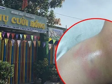 Xác minh vụ việc bé gái 4 tuổi nghi bị cô giáo đánh bầm tím
