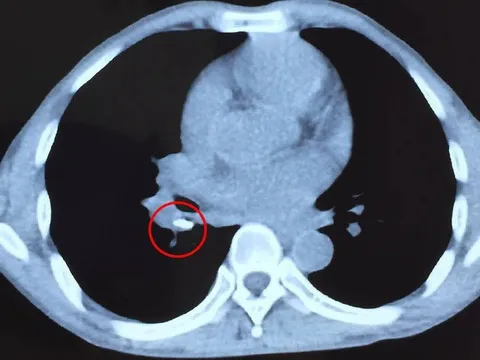 Đau nhức đầu khi đi bơi, nam thanh niên rơi vào hôn mê do xuất huyết não