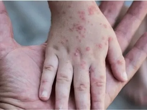 Hàn Quốc ghi nhận 2 ca nghi mắc bệnh đậu mùa khỉ đầu tiên