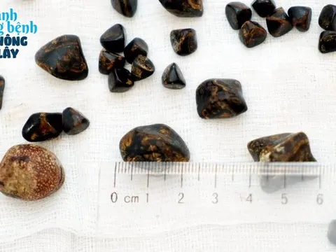 Cắt nguyên túi mật chứa 30 viên sỏi ở cụ bà 84 tuổi: Dấu hiệu sớm cảnh báo bệnh bị bỏ qua