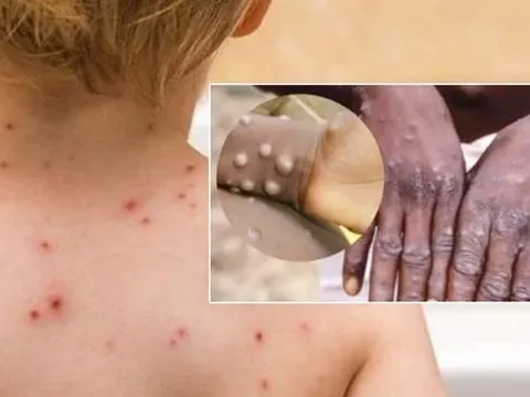 Triệu chứng điển hình của bệnh đậu mùa khỉ và cách điều trị