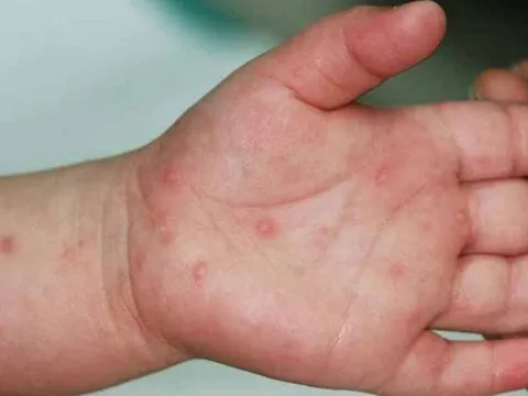 Hà Nội: Số ca tay chân miệng tăng gấp 4, đặc biệt chú ý 3 dấu hiệu này