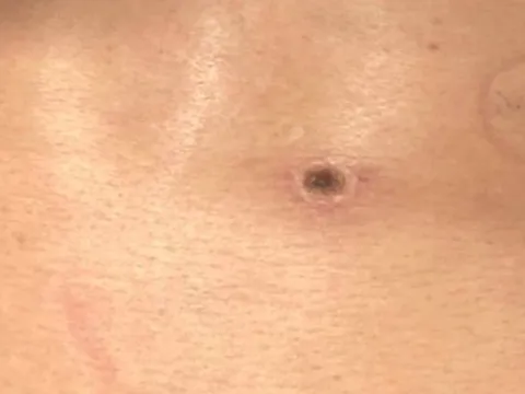 Sốc nhiễm khuẩn, suy đa tạng do sốt mò: Phòng bệnh thế nào?