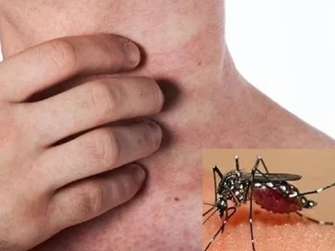 Khi bị sốt xuất huyết cần ghi nhớ 5 lưu ý "vàng" để nhanh hồi phục