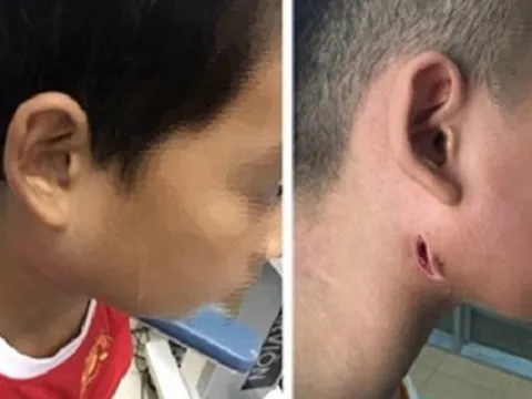 Đắk Lắk: Phát hiện 1 bệnh nhi mắc bệnh "vi khuẩn ăn thịt người"