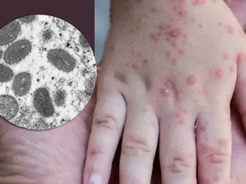 Cảnh báo nhiều ca mắc đậu mùa khỉ là trẻ em