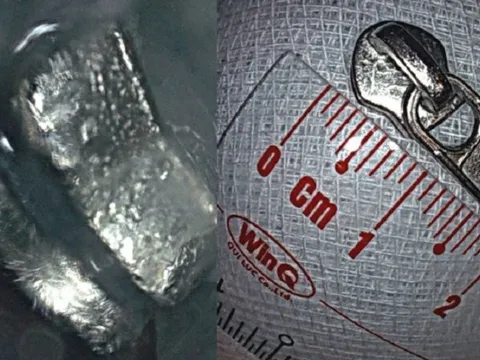 Phát hiện đầu khóa kéo trong dạ dày bé trai 6 tuổi