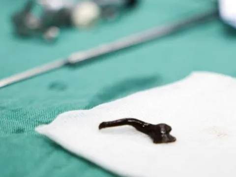 Kinh hãi vắt rừng sống trong đường thở của bé 11 tuổi cả tháng trời