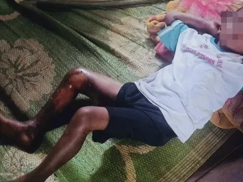 Công an thông tin vụ bé trai 8 tuổi bị đốt bỏng chân