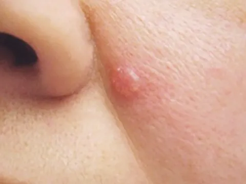 4 năm chữa nốt sần dưới cánh mũi không khỏi, người phụ nữ mắc bệnh nguy hiểm ít người để ý