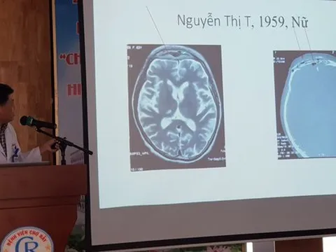 Hàng loạt ca Covid-19 áp xe, hoại tử sọ mặt