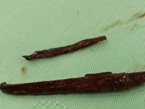 Cứu bệnh nhân bị 2 mảnh gỗ văng vào đâm thủng ruột non khi đang cưa gỗ