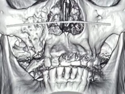 Bộ Y tế yêu cầu xác định nguyên nhân gây bệnh hoại tử xương hàm mặt