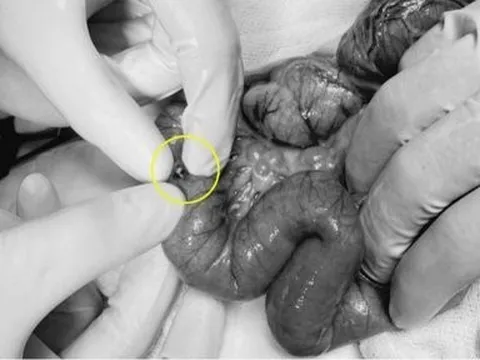 Thêm bé gái 3 tuổi thủng ruột vì món đồ chơi quen thuộc