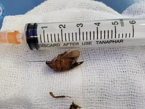 Hy hữu: Gián vẫn còn sống được gắp ra từ tai người