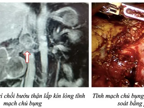 Robot cắt thận và lấy chồi bướu ca bệnh đầu tiên Việt Nam