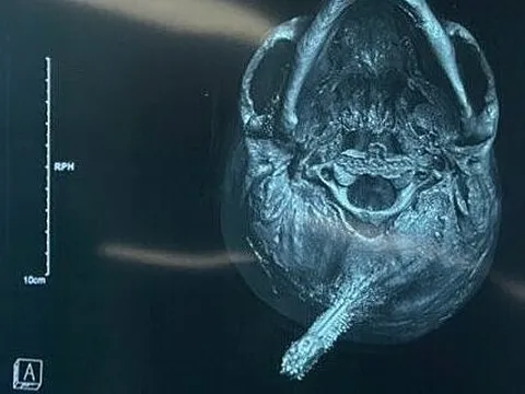 Chìa khóa cắm xương sọ nam thanh niên