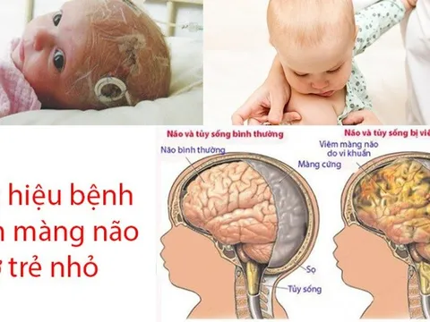 Những dấu hiệu nào báo hiệu bệnh viêm màng não ở trẻ em?