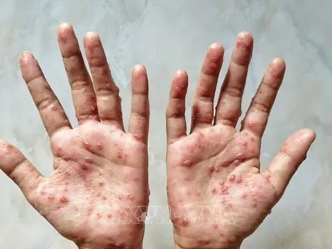 Bệnh đậu mùa khỉ lây truyền từ người sang người như thế nào?