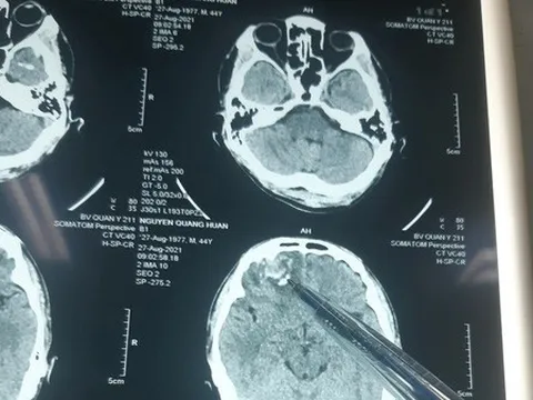 Bộ Công an vào cuộc vụ dân tố bị đánh tổn hại 35% sức khỏe, công an huyện không khởi tố