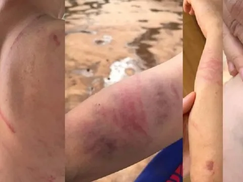 Khởi tố cha ruột và bà nội đánh cháu bé 9 tuổi thương tích đầy người