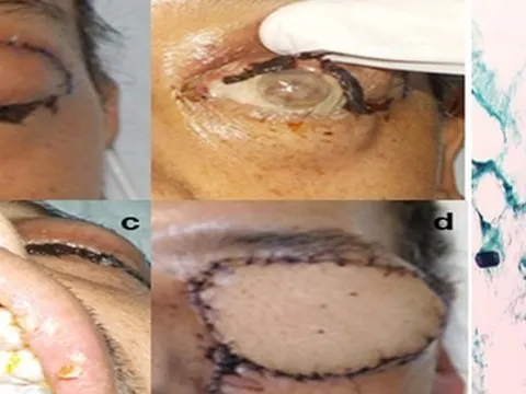 Hà Nội ghi nhận 3 ca hoại tử xương hàm