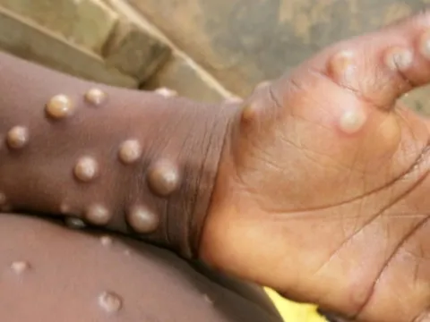 Lý do WHO tuyên bố đậu mùa khỉ là tình trạng khẩn cấp y tế toàn cầu