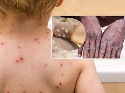 Châu Âu chấp thuận vắc-xin phòng đậu mùa khỉ