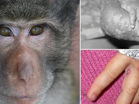 Hơn 16.000 người trên thế giới mắc đậu mùa khỉ, Bộ Y tế khuyến cáo 6 biện pháp phòng chống