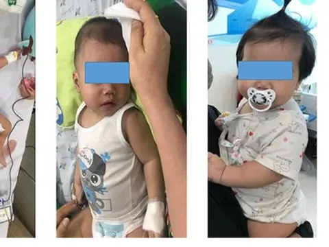 Nhiều trẻ dưới 1 tuổi nguy kịch vì sốt xuất huyết do nhầm với bệnh khác