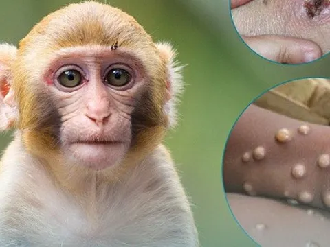 Bệnh đậu mùa khỉ: Các khuyến cáo giảm nguy cơ lây bệnh