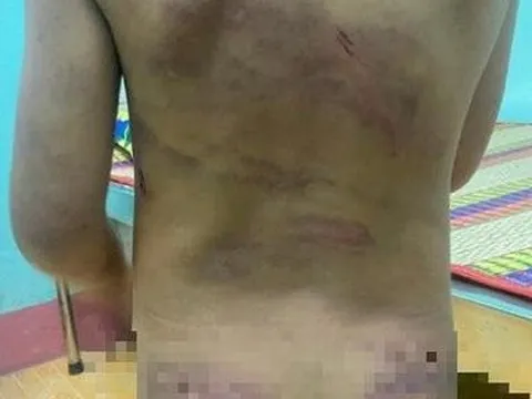 Vụ bé gái 7 tuổi chi chít vết thương: Bị mẹ và cha dượng đánh?