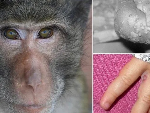 Nóng: Bộ Y tế ban hành hướng dẫn chẩn đoán, điều trị và phòng bệnh đậu mùa khỉ ở người