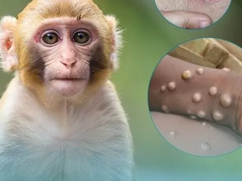 Bộ Y tế ban hành hướng dẫn chẩn đoán, điều trị và phòng bệnh đậu mùa khỉ ở người