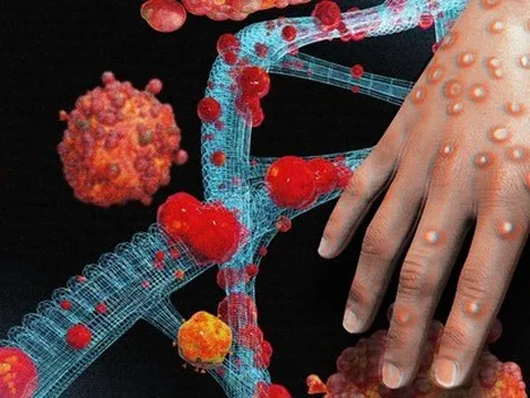 Bệnh đậu mùa khỉ: Ai dễ nhiễm và dễ bị bệnh nặng?