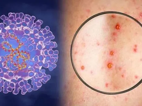 Mới: Ba tình huống bệnh đậu mùa khỉ xuất hiện tại Việt Nam