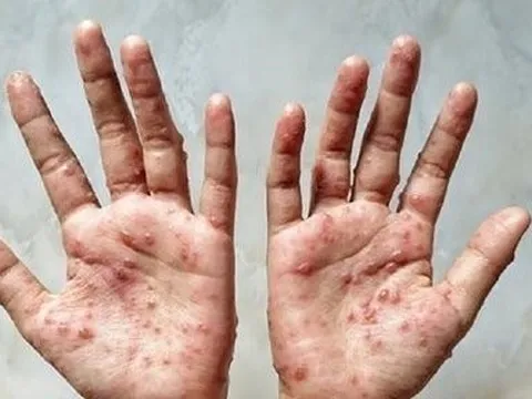 Sẵn sàng kịch bản ứng phó với bệnh đậu mùa khỉ