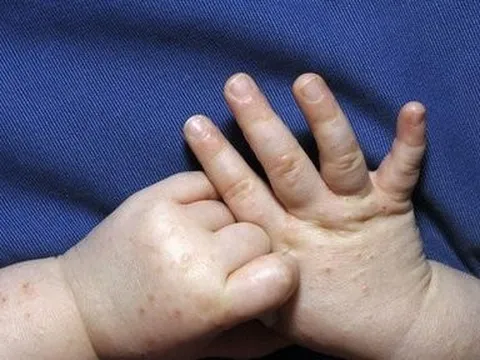 Bệnh đậu mùa khỉ ở trẻ em: Những điều cha mẹ cần biết về các nguy cơ và biện pháp phòng ngừa