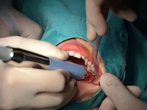 Áp xe vùng mặt - Hậu quả nặng nề khi chủ quan với biến chứng mọc răng khôn